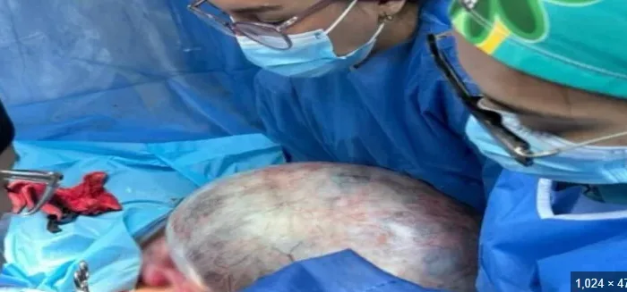 Le extraen un tumor de 25 kilos a una mujer