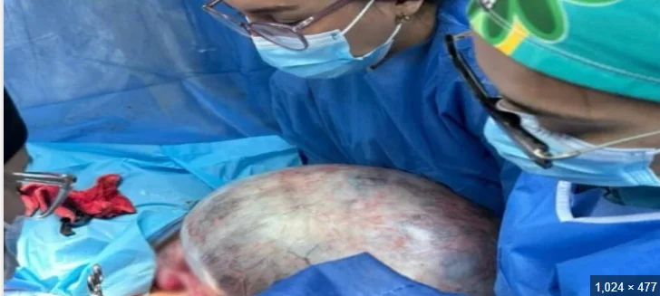 Le extraen un tumor de 25 kilos a una mujer